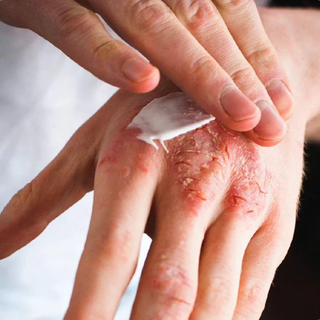 The Truth About Steroid Creams and Your Child’s Skin.