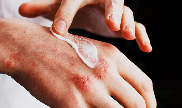 How to Calm an Eczema/Psoriasis Flare-Up Without Reaching for Steroids.