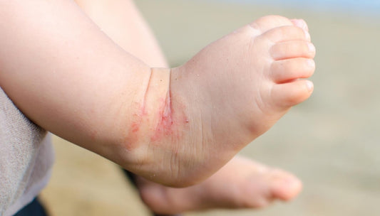 Eczema in Children Common Causes and Treatments for Little Ones