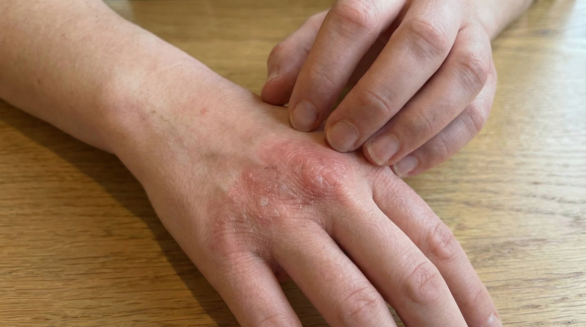 How to Stop Eczema Itching Fast: What Works for Lasting Relief