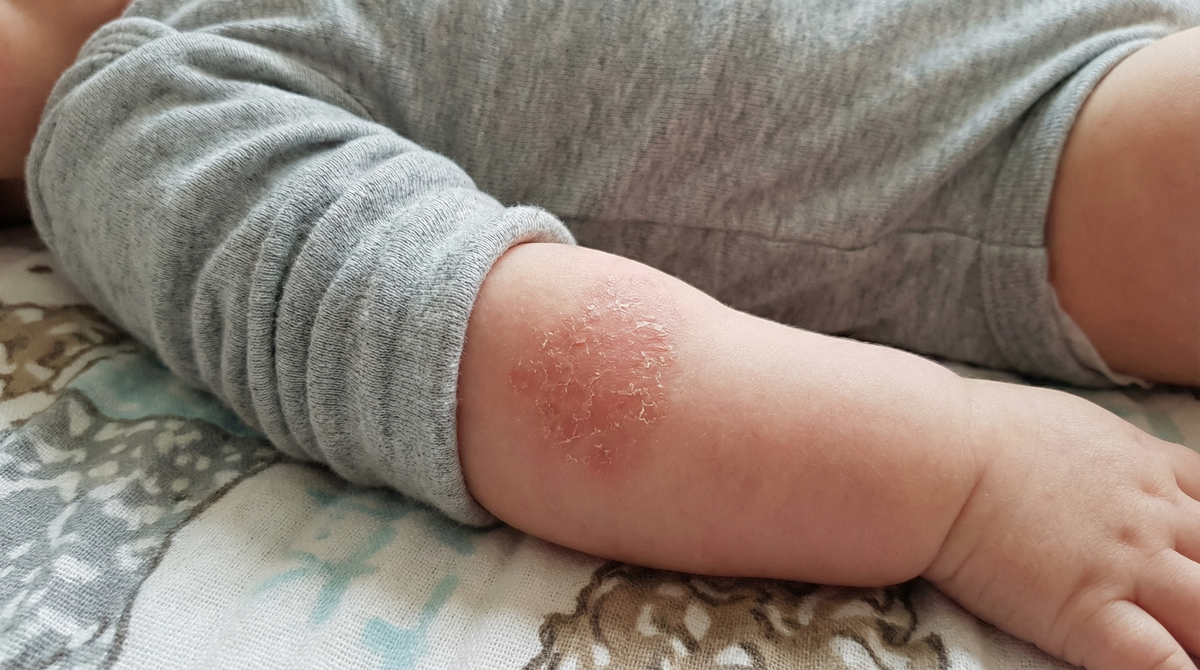 Toddler Eczema Treatment: What Actually Works and What's Safe