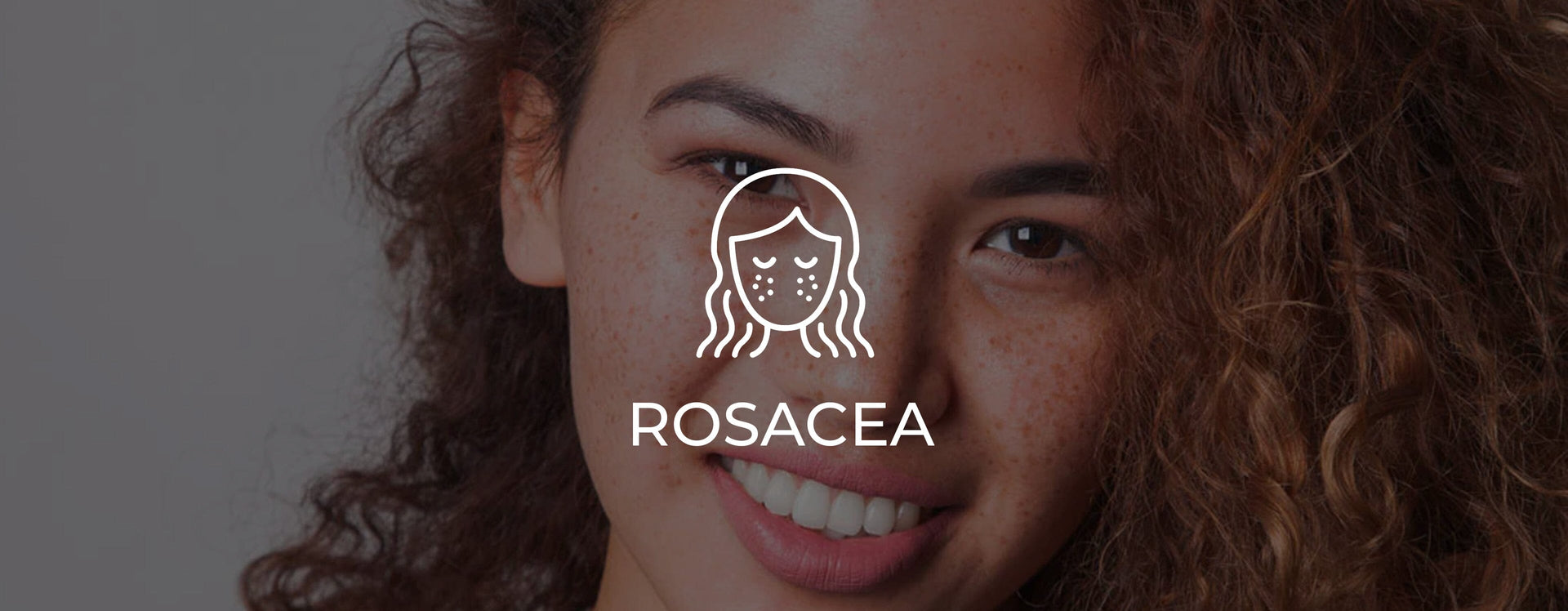 Rosacea